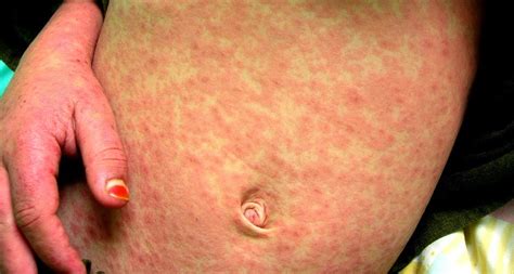 Moderna vaccine leaves some patients with itchy (but harmless) rash. Measles in the U.S. and the MMR (Measles, Mumps, Rubella ...