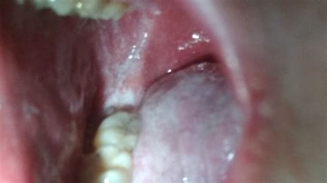 Causes Of Swollen Tonsils Pictures And Treatment Including Home Remedies