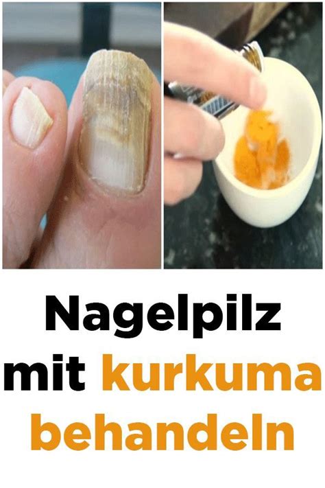 Nagelpilz Mit Kurkuma Behandeln Nail Fungus Fungus Treatment Nail