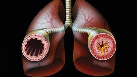 Increased blood volume (excessive preload) 2. Mechanism of breathing and causes of asthma | The Guardian ...