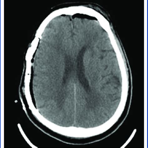 Ct Scan Showing An Acute Subdural Hematoma With Mass Effect And Midline