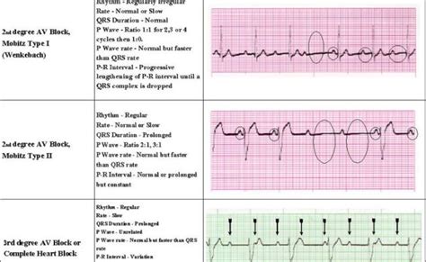 80 Best Images About Acls On Pinterest Ventricular Tachycardia Studying
