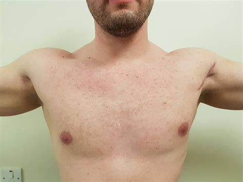Pec Major Tendon Tears The Shoulder And Elbow Clinic