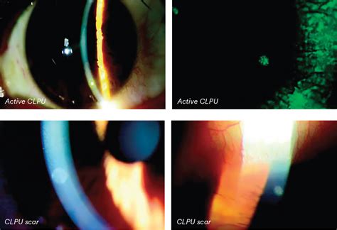 How To Manage Patients With Clpu Contact Lens Peripheral Ulcer