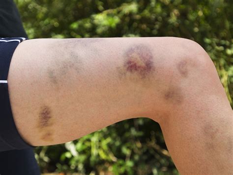 Causes Of Easy Bruising Reasons Why People Bruise Easily