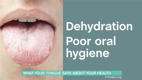 13 Health Warning Signs On Tongue You Must Not Ignore Including Covid