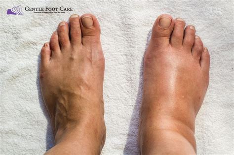 Swelling In Your Feet Or Ankles Should Never Be Ignored Gentle Foot Care