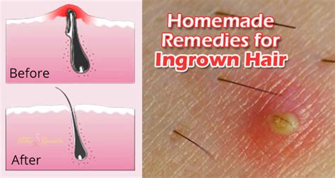 How To Get Rid Of Ingrown Hair 10 Amazing Remedies