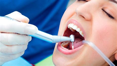 Las 9 Dudas MÁs Frecuentes Sobre La Limpieza Dental Perudentus Clinica Dental En Huaraz
