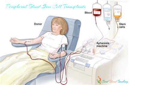 Bone Marrow And Peripheral Blood Stem Cell Transplants Cord Blood Banking