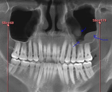 Mucosal Retention Cyst From Wisdom Tooth Removal Rdentistry