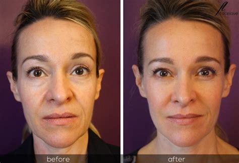 Facial Reshapping Before And After At Facelove Facelove
