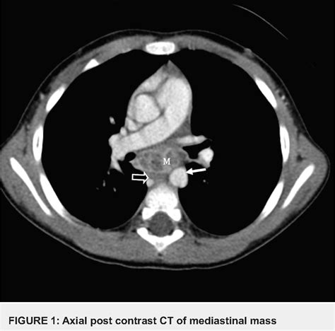 Figure 1 From Pediatric Atypical Mycobacterium Infection Presenting As