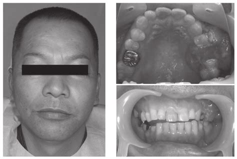 A Marginal Facial Asymmetry Was Observed On The Left Side Of The
