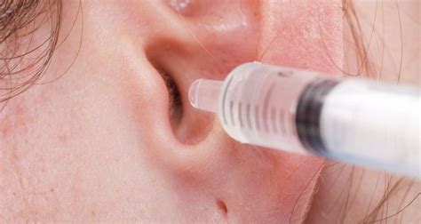 Removing Earwax With Hydrogen Peroxide Earwax Ear Wax Removal Ear