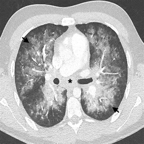 Computed tomographic and clinical features of pulmonary veno-occlusive