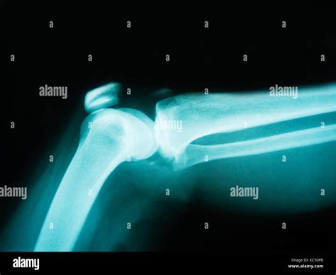 X Ray Of Human Arm Showing Broken Bone Stock Photo Alamy