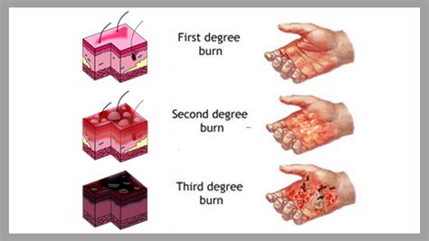 As your burn begins to heal, it will look and feel dry. Texas Burn Injury Attorney - Third-Degree Burns