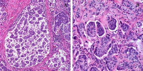Variants Of Gastric Carcinoma Morphologic And Theranostic Importance