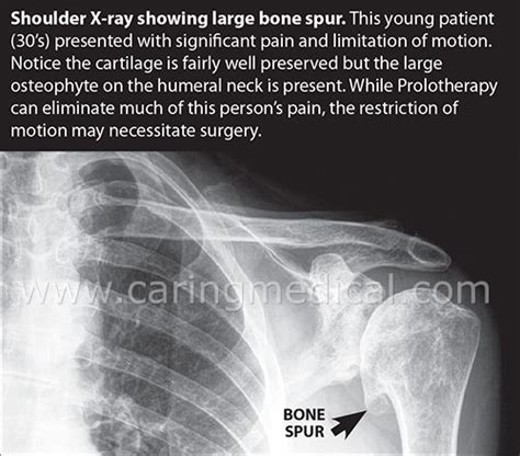 Bone Spurs In The Shoulder Caring Medical