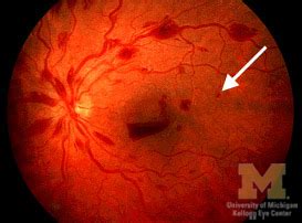 The wesdr stated that moderate npdr contains dot blot hemorrhages (dbh) or microaneurysms (ma) as numerous and severe as the standard photo 2a below in at least one quadrant, with or without cotton wool spots (cws), venous beading, or irma, but not achieving the 4:2:1 rule. Diabetic retinopathy physical examination - wikidoc