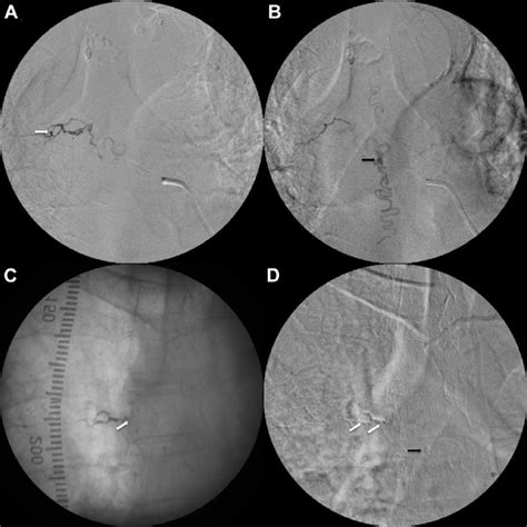 Preoperative Selective Angiography Images Of Early A And Late B