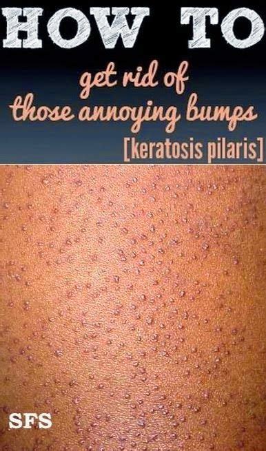 Get Rid Of Bumps Arms Get Rid Of Bumps