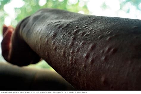 Poison Ivy Rash Symptoms And Causes Mayo Clinic