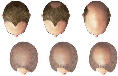 How To Deal With Androgenic Alopecia Aga