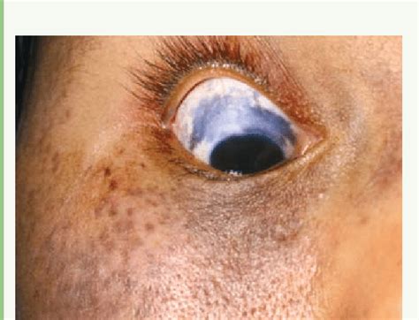 Paciente Mujer 36 Años Con Melanocitosis Oculodermal Se Puede Apreciar