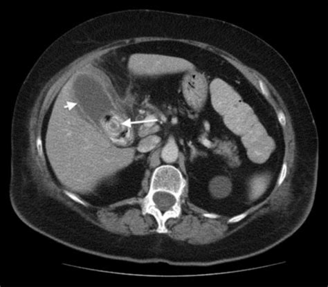 Abdominal Ct Image Showing Gallbladder Distension Wall Open I