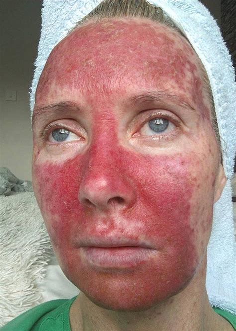 Irish Mum Warns Of Tanning Dangers With Pre Cancer Treatment Pics
