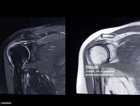 Magnetic Resonance Imaging Or Mri Of Shoulder Joint Coronal T2 Fs And