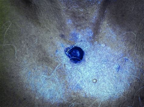 Seborrheic Keratosis Over Chest With One Area Showing Rolled Out