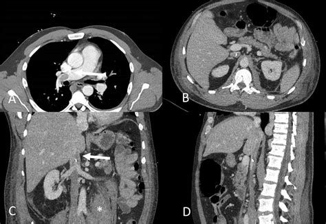 Ct Chest Abdomen Pelvis Obtained Two Days After Intervention Is Shown