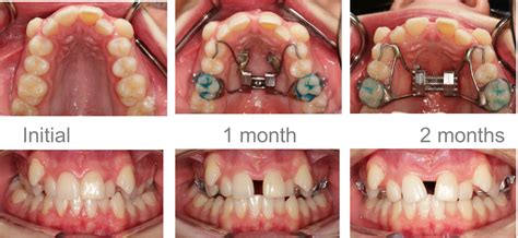 What's the best brace to fix my crossbite? Patient T.G. - Dental crowding, crossbite > Expander ...