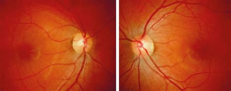 Superior Segmental Optic Nerve Hypoplasia Differential Diagnosis With