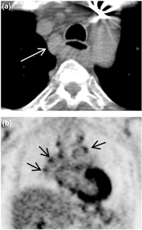 Axial Ct Image A Revealed Lymph Node Enlargement On 2r Arrow