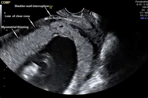 Transvaginal Ultrasonography Showing Placenta Percreta With Urinary My Xxx Hot Girl