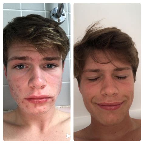Just got off accutane. Before and after for inspiration~ : acne