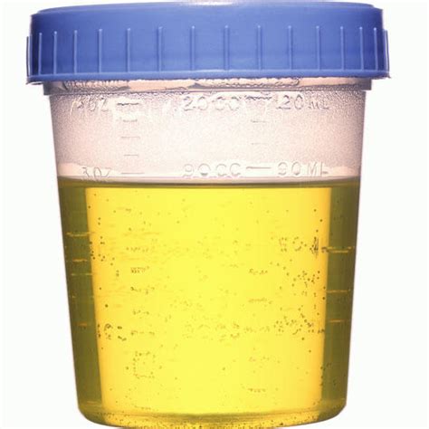 Foamy Urine Pictures Causes Treatment Diagnoses Healthmd