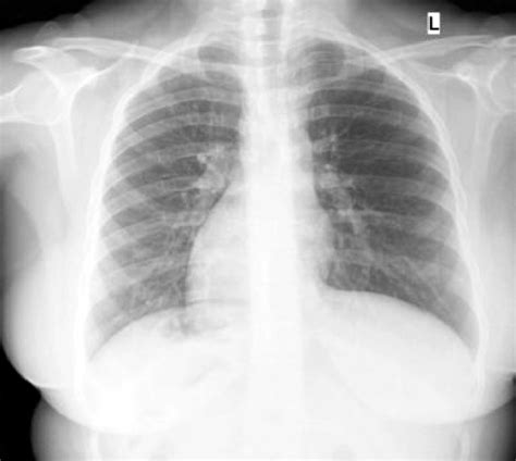 X Ray Chest Pa Postero Anterior View Showing The Dila