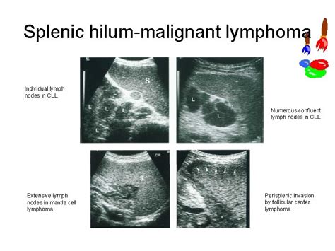 Lymph Nodes Differential Diagnosis In Ultrasound Imaging P