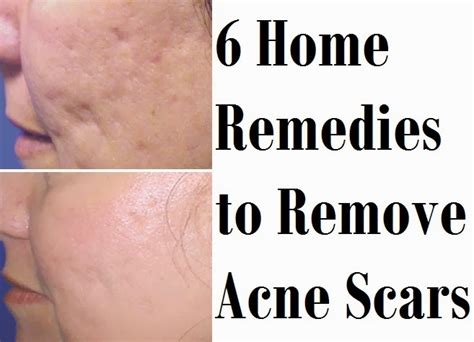 Acne Treatment Home Remedies Dorothee Padraig South West Skin Health Care
