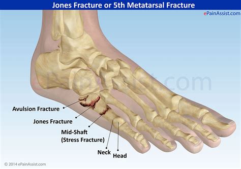 Metatarsal Stress Fracture Foot Symptoms