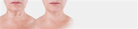 Non Surgical Neck Lift Bakersfield Neck Skin Tightening