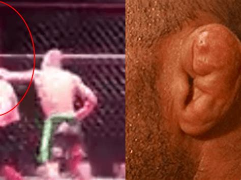 Mcgregor Cauliflower Ear Mma Fighter S Eye Pops Out After Kick To The