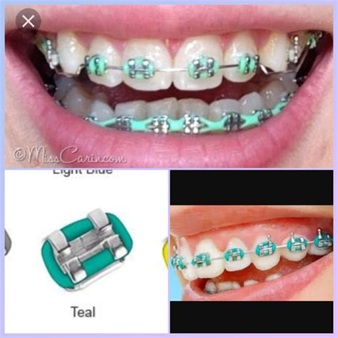 Best Braces Colors For Guys