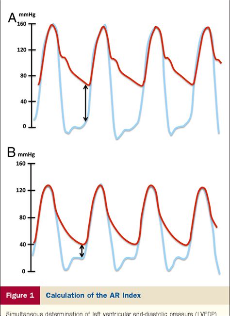 Valvular Heart Disease Aortic Regurgitation Index Defines Severity Of