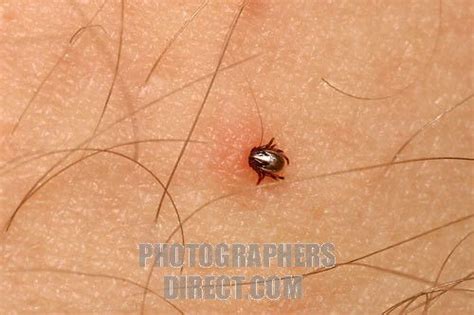 Tick Under Skin Tiny Tick On Human Skin Stock Photo In 2020 Ticks